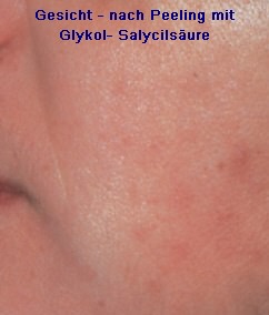 Gesicht nach Glykol-Salycilsäure-Behandlung